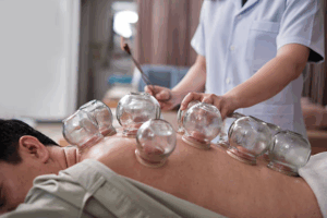 How Cupping & Dry Needling Accelerate Soft Tissue Healing