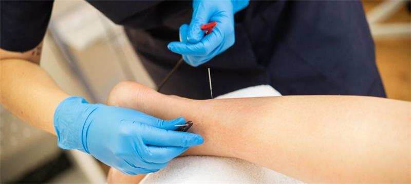 How Cupping & Dry Needling Accelerate Soft Tissue Recovery